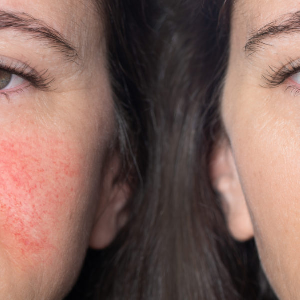 A close-up portrait of before and after a Caucasian woman showing redness and inflamed blood vessels on her cheeks. The concept of rosacea. High quality photo