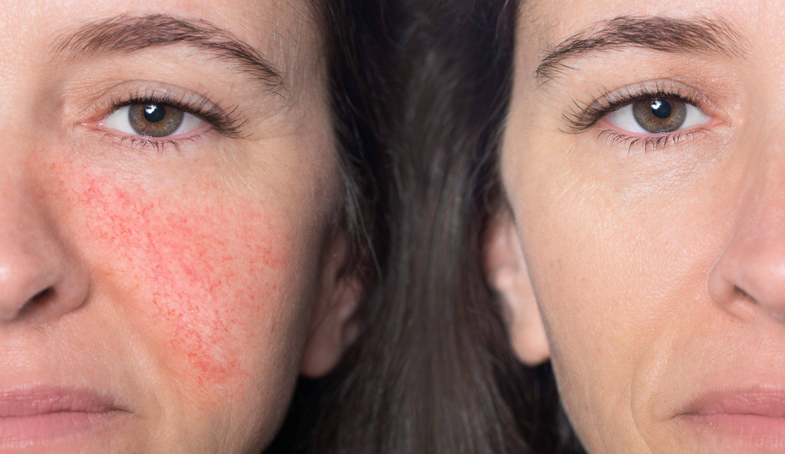 A close-up portrait of before and after a Caucasian woman showing redness and inflamed blood vessels on her cheeks. The concept of rosacea. High quality photo