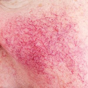 This is an image showing Rosacea (Original Chinese: 紅斑痤瘡, 酒糟鼻) (Source: The Selfology Skincare Guide—A Comprehensive Skincare Guide for All Skin Types and Complexions —selfology,co/skincare— Autumn Edition)