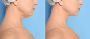 Mature woman before and after plastic surgery operation on blue background, closeup. Double chin problem