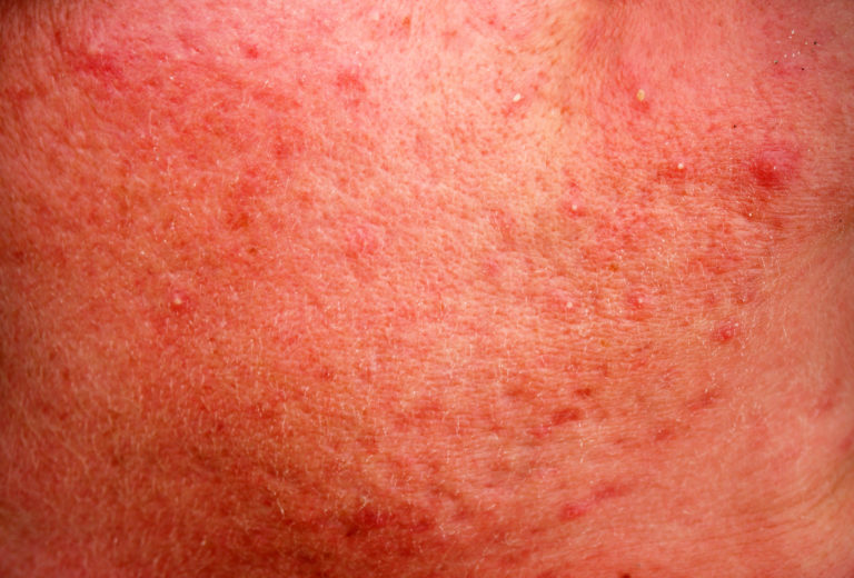 rosacea skin disease on the face Condition Name: Acne Rosacea Source: Selfology Skincare Guide selfology.co/Skincare